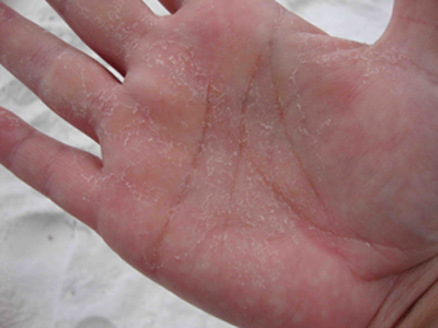 Itchy rash on palms of hands - Dermatology - MedHelp