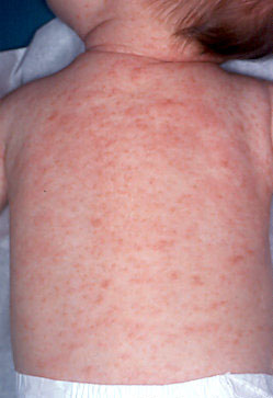 Beginning Of Scabies