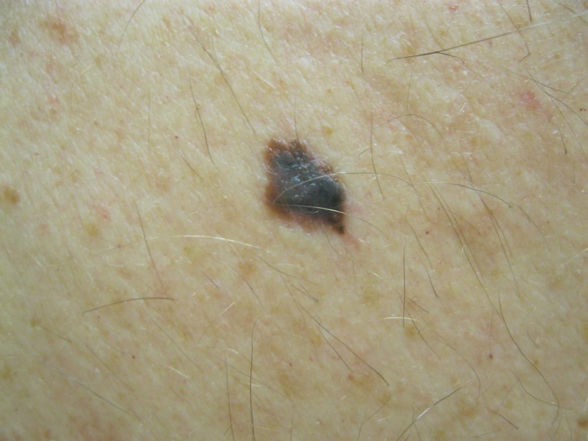 Small Black Spot On Skin Pictures Photos