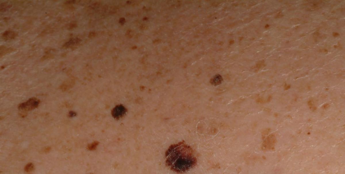 Skin Cancer Moles