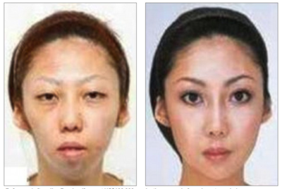 Cosmetic Surgery Of The Asian Face 72