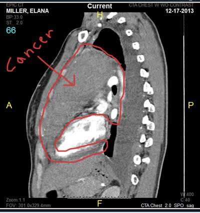 ct cancer scan shit does look holy tumor lymphoma spot bone contrast heart lungs shows front bright sagittal fluid ruled