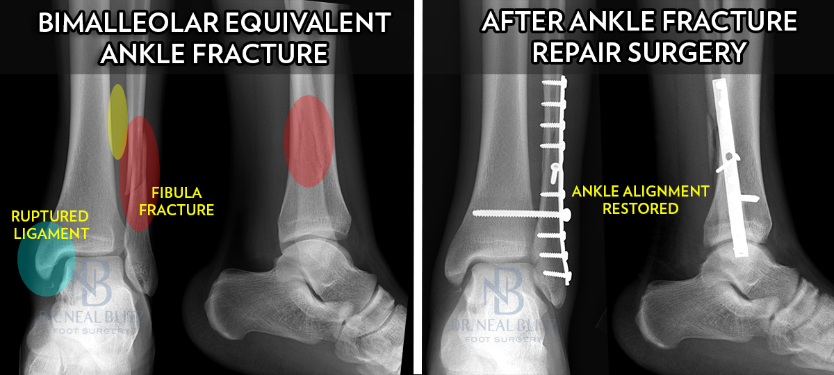 How easy is it to break an ankle?