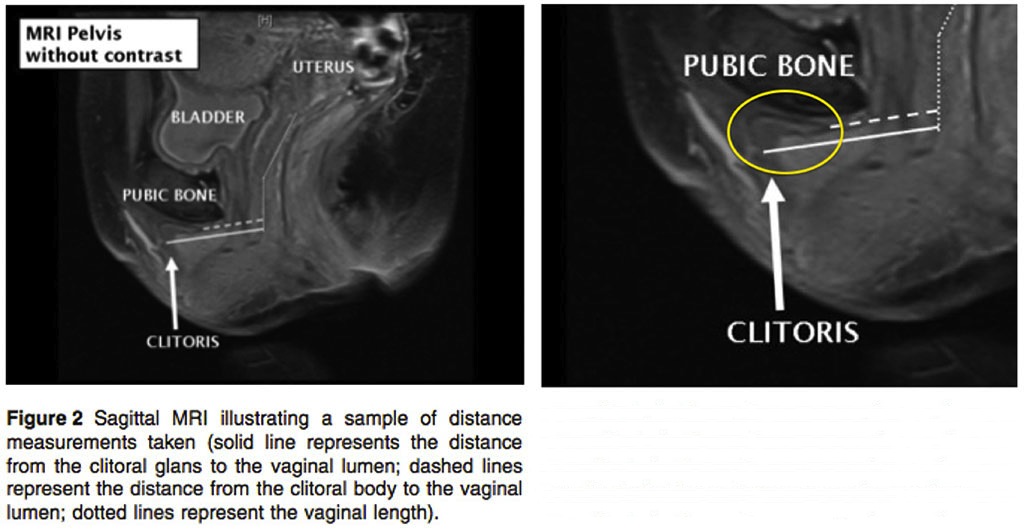 Having A Smaller Clitoris Is Associated With Anorgasmia Huffpost