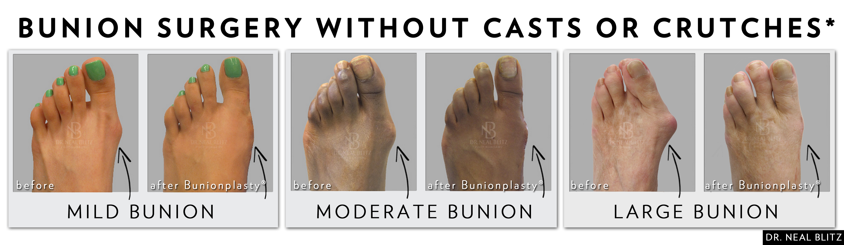 bunion surgery shoes wearing after