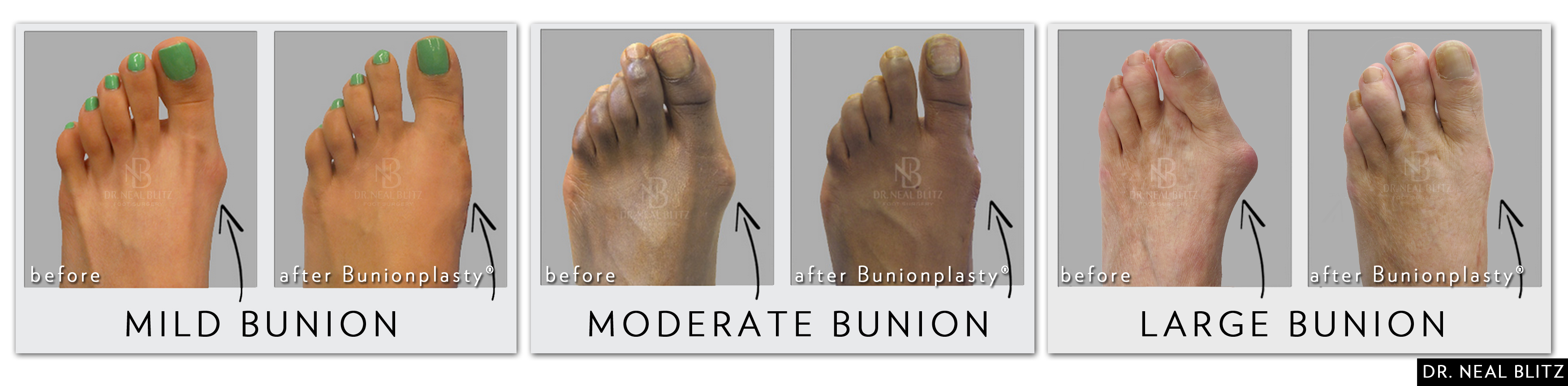 What treatment is available for foot bunions?