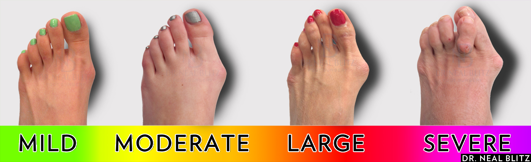 6-best-bunion-surgery-pros-cons-get-the-fastest-recovery-time-youtube