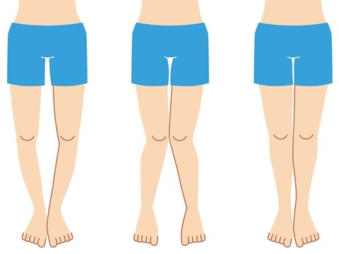 左からO脚、X脚、理想的な脚の形。