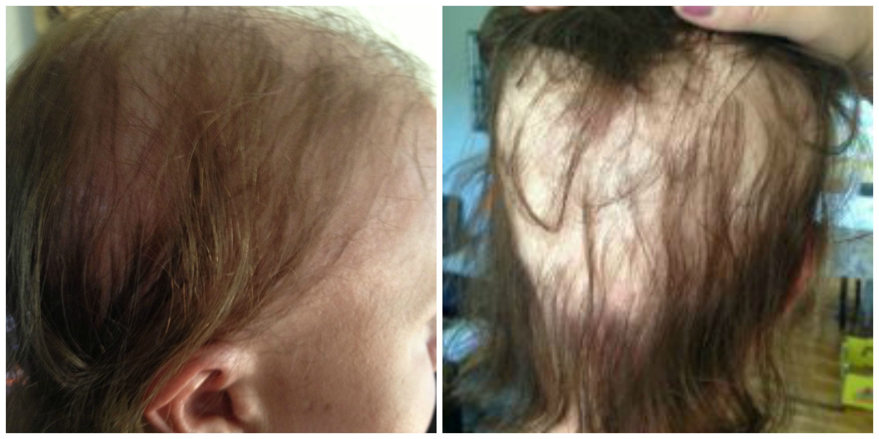 I Lost All My Hair During Pregnancy HuffPost