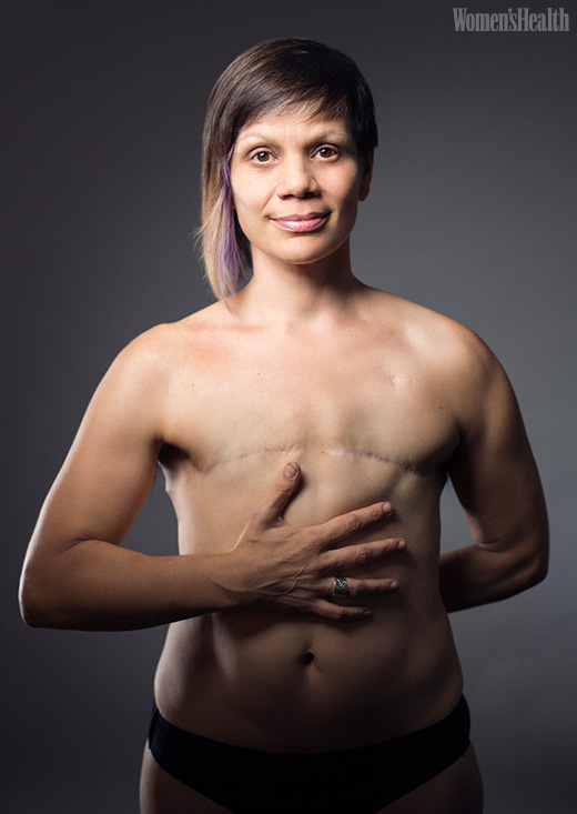 Woman after mastectomy. A girl without breasts tries on a breast