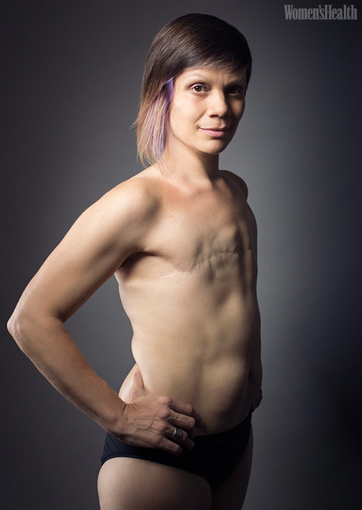 Woman after mastectomy. A girl without breasts tries on a breast