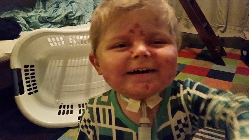 Help Save Easton- baby battling Epidermolysis Bullosa- EB