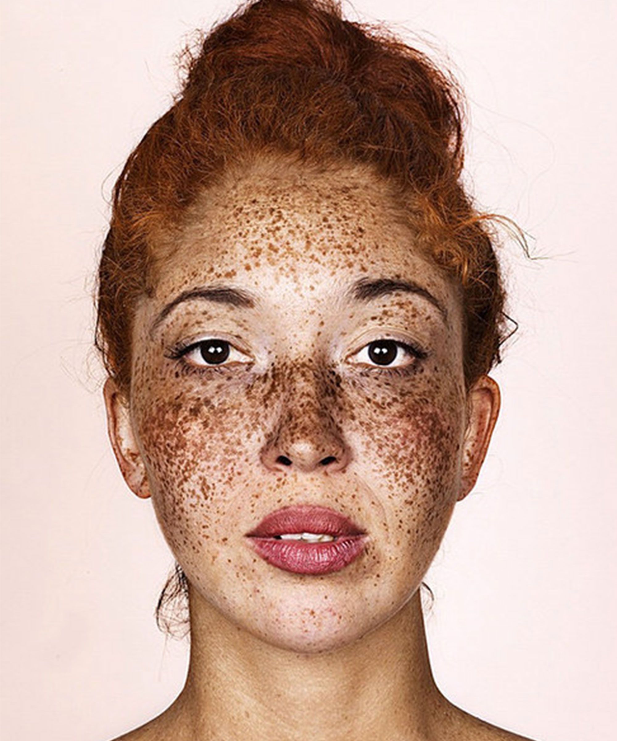 freckles on face