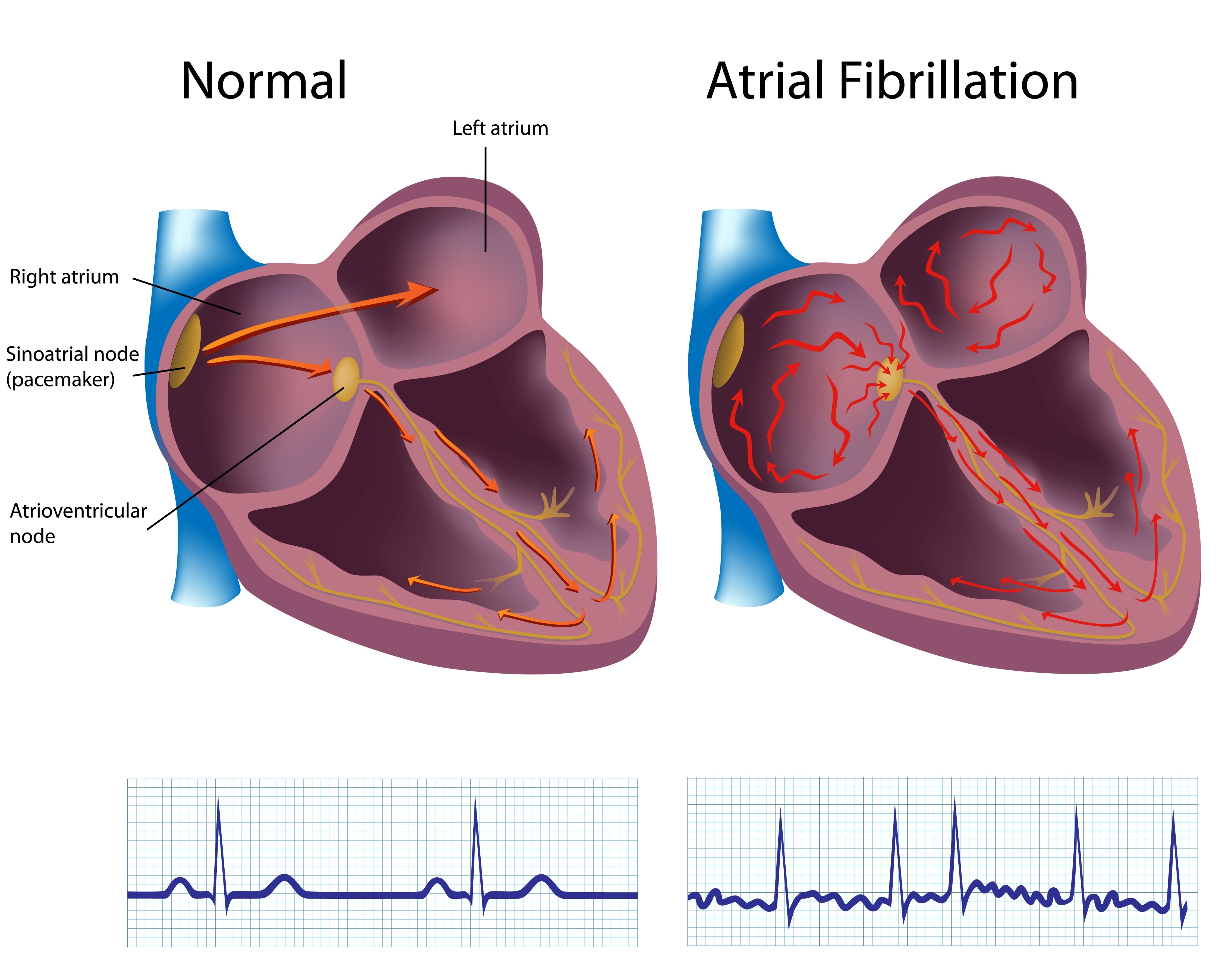 Got AFib? You May Have OSA HuffPost