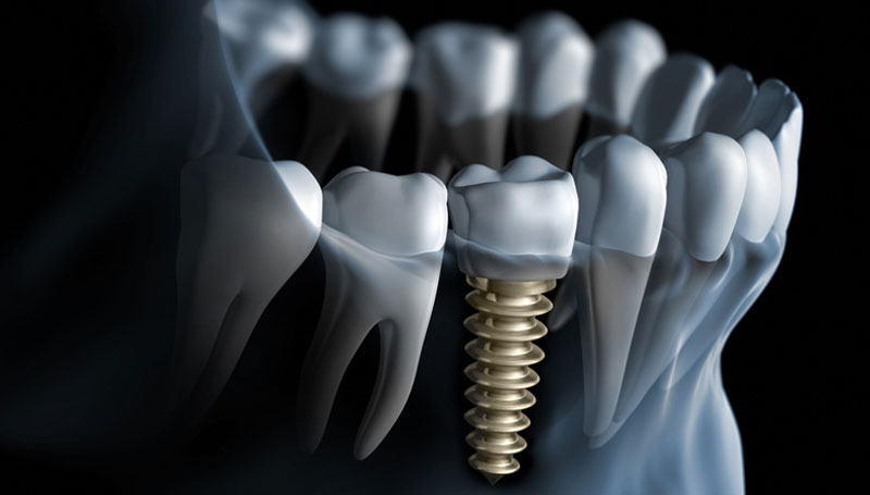 dental implants know things should teeth tooth screenshot