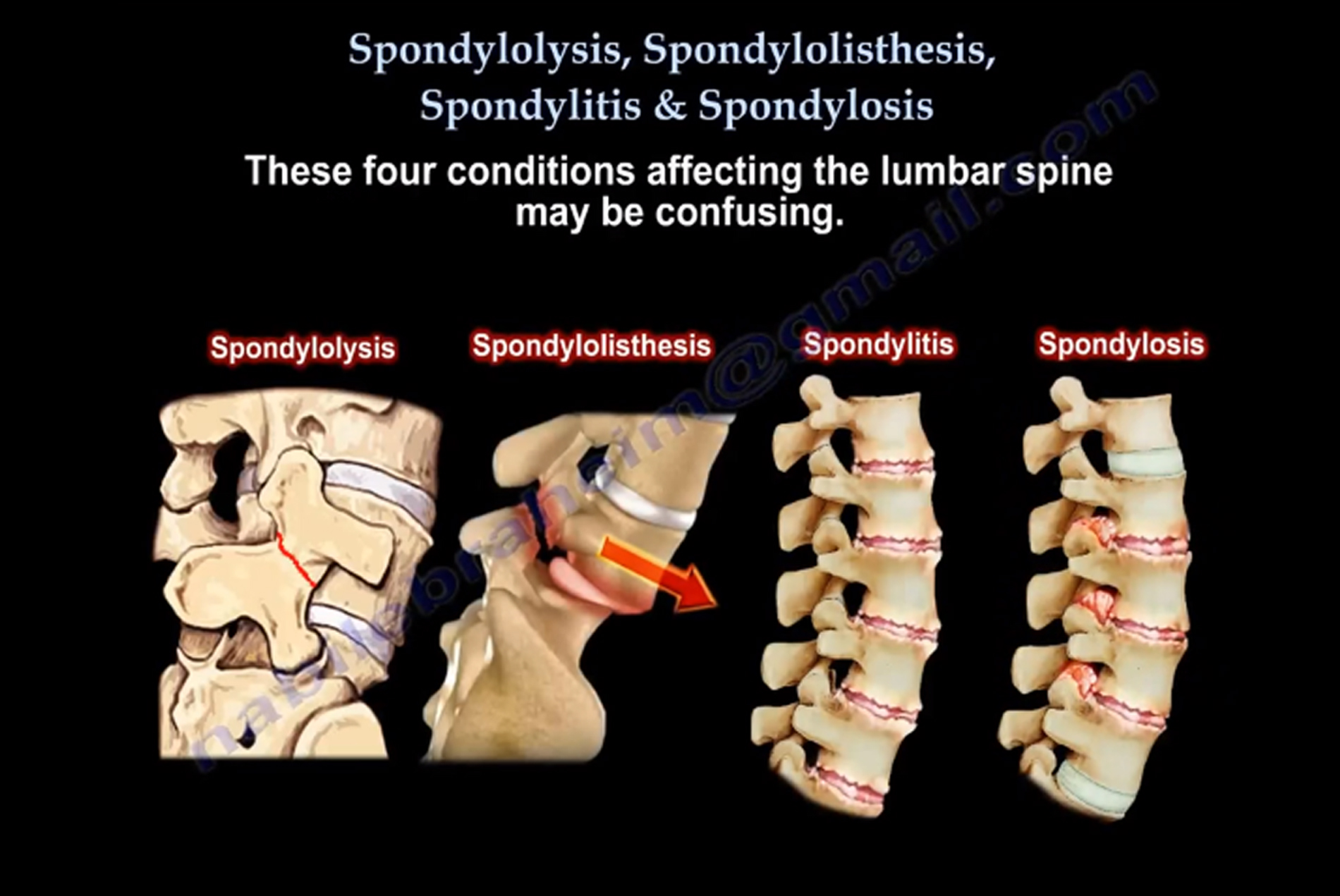 Lumbar Spondylosis Meaning In English