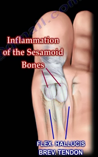 Big Toe Pain: Bunions, Gout, Turf Toe and Sesamoiditis | The ...