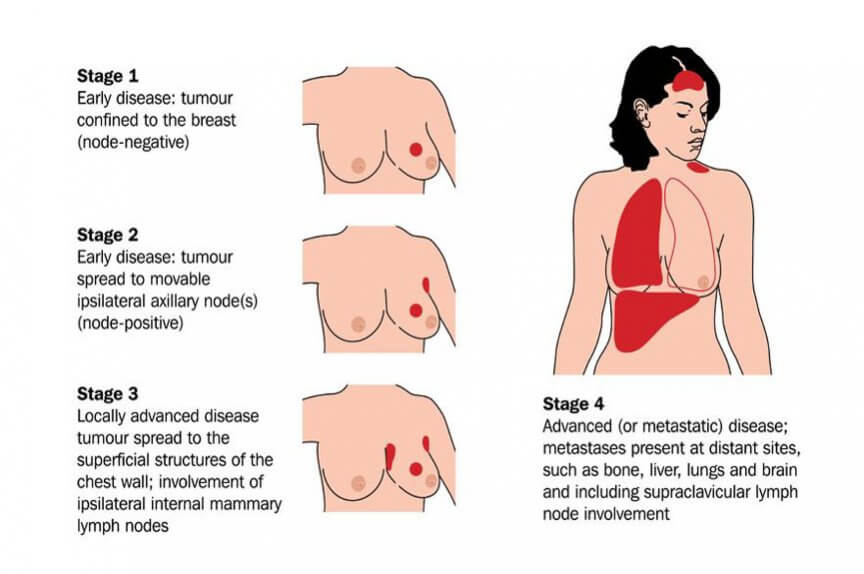 How Do Breast Cancer And Metastatic Breast Cancer Differ