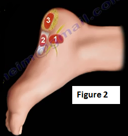 nerve pain in heel