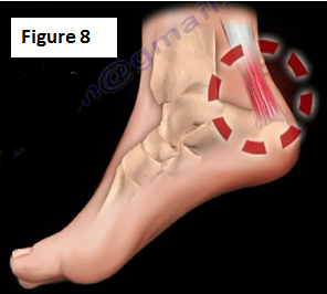 Are steroid injections for plantar fasciitis painful