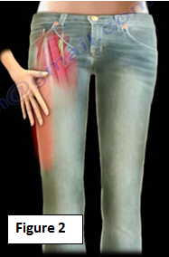 Jeggings And Tight Jeans Can Cause Meralgia Paresthetica