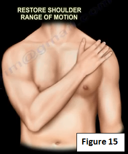 Side effects of steroids injections in the shoulder