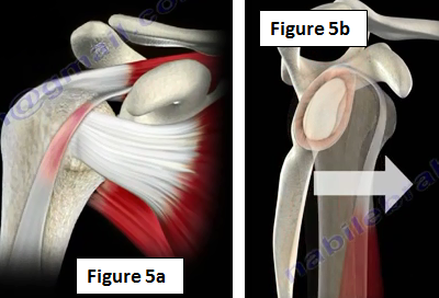 Snapping Scapula Syndrome | HuffPost