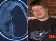 Michelle Mack: Woman Born With Half A Brain