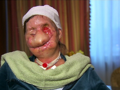 Charla Nash, Chimp Attack Victim, Shows Face On 