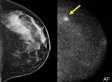 The Secret History Of Mammography