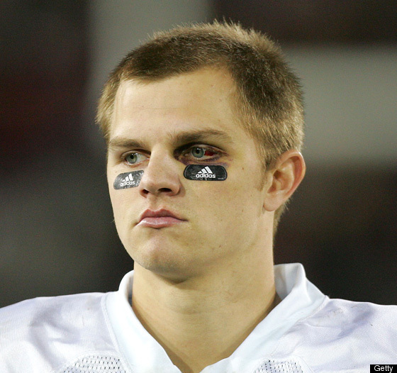 clausen. Jimmy Clausen Black Eye 