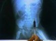 Boy With 42 Needles Stuck In Him Airlifted To Hospital