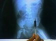 Brazil Man: Needles Were Meant To Kill My Stepson