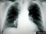 Cigarette Company Funded Lung Cancer Study