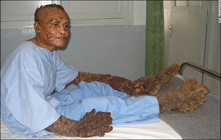 dede tree man. Tree Man Has Surgery,