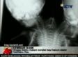 Conjoined Twins Born With One Body, Two Heads In Indonesia (VIDEO)