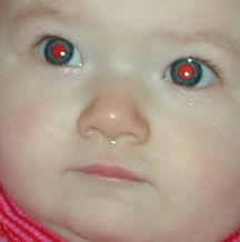 red ring around pupil of eye