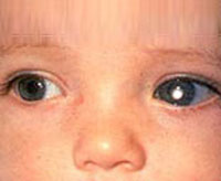 2010-08-23-retinoblastoma.jpg