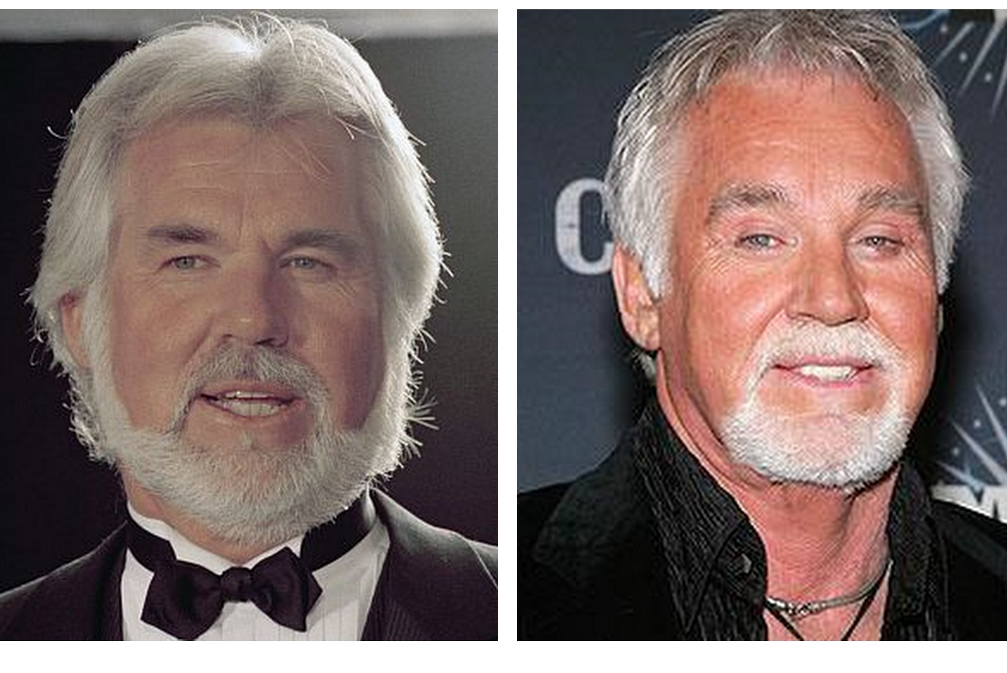 Kenny rogers deals plastic surgery