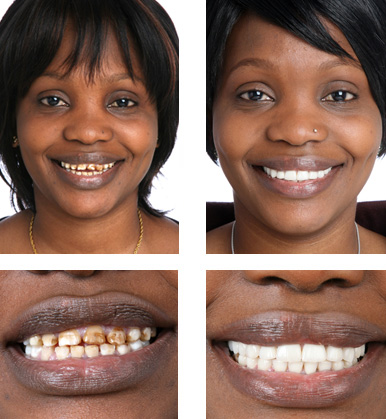 veneers smile porcelain teeth gummy gum correct laser brit reduction renew presented cosmetic huffingtonpost ba11