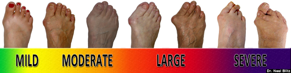 bunions foot bunion symptoms pain know toe rid feet severe something does mild painful treatment valgus hallux things why fix