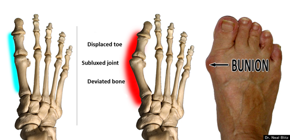 bunion pain while running