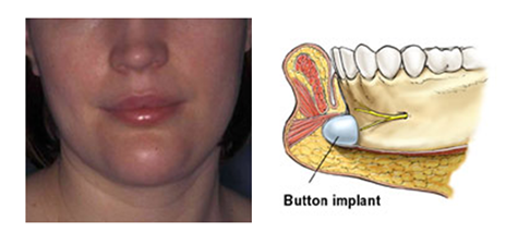 2012-06-13-buttonimplant.png