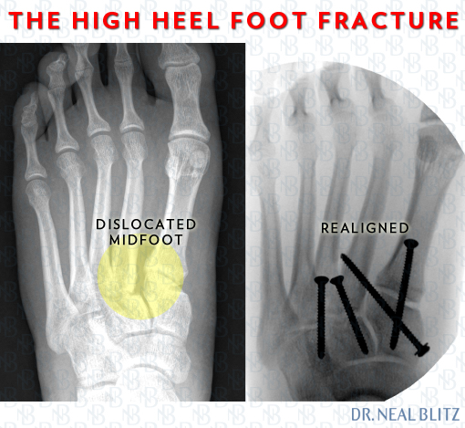 The High Heel Foot Fracture: A Real 