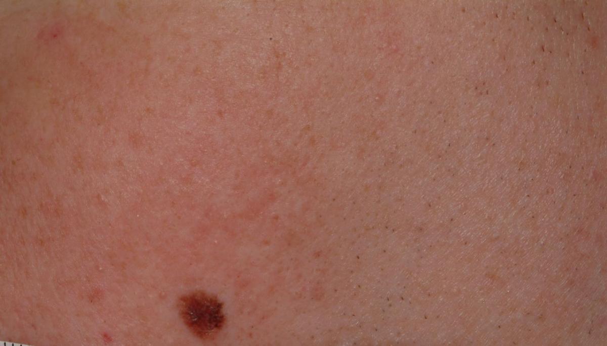 Skin Cancer Spots On Arm