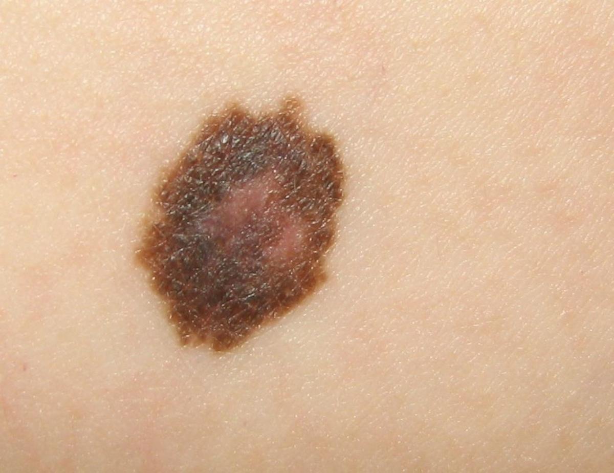 Skin-Cancer Apps Can Be Dangerously Wrong | HuffPost