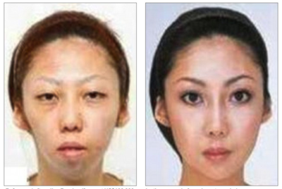 asian face surgery