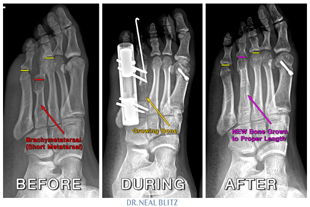 2013-06-09-BrachymetatarsiaSurgeryDrBlitz.jpg