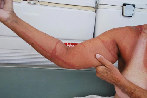 box jellyfish attack