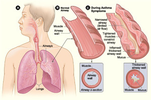2013-12-20-asthma.jpg